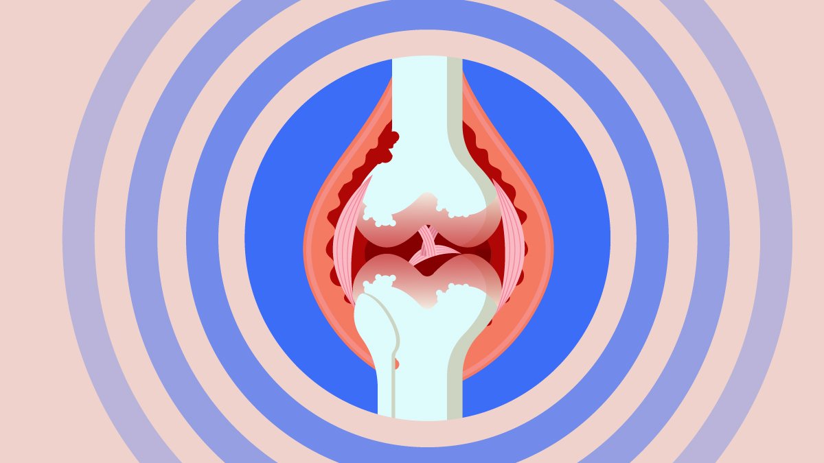 Illustration of an inflamed joint