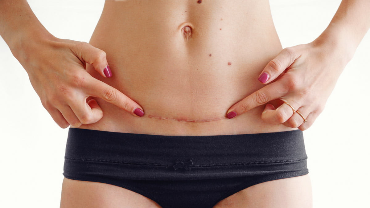 Woman Belly with Scar from Cesarean Section Operation