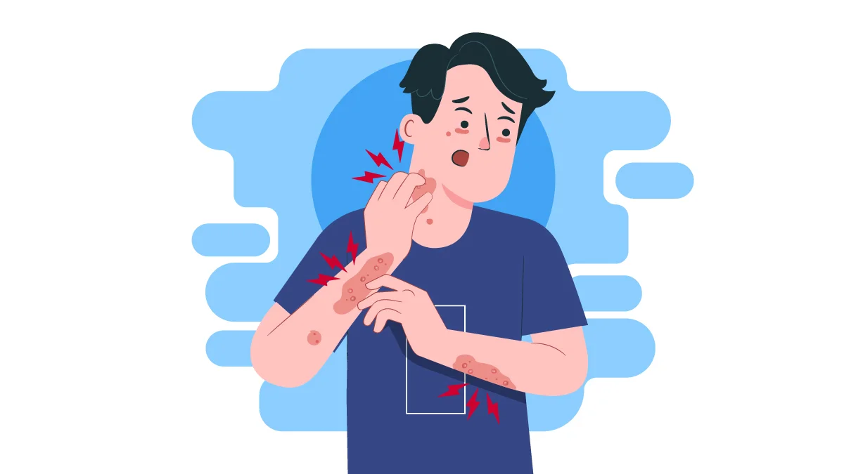 Person with Shingles in His Neck and Arms Scratching