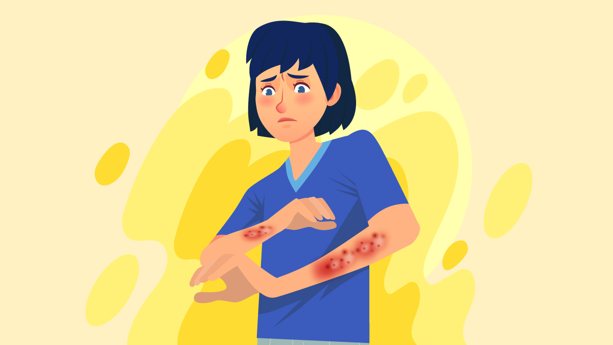 Illustration of a Person with Eczema on Her Arms