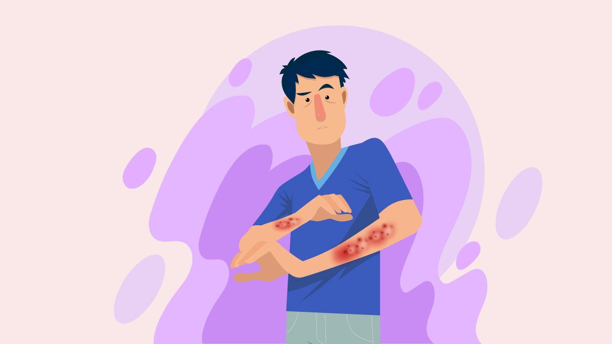 Illustration of a Person with Eczema on His Arms