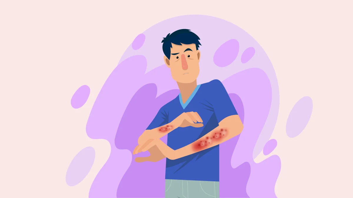 Illustration of a Person with Eczema on His Arms