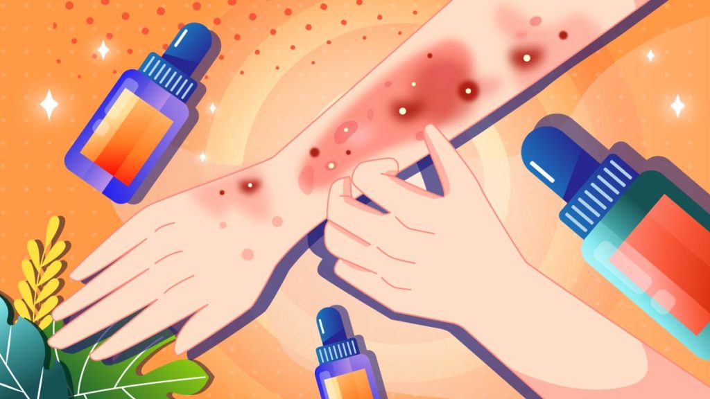 CBD Oil for Eczema Can It Help? CFAH