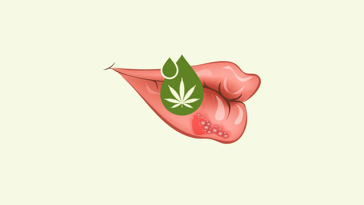 Illustration of cannabis treatment for a lip with herpes