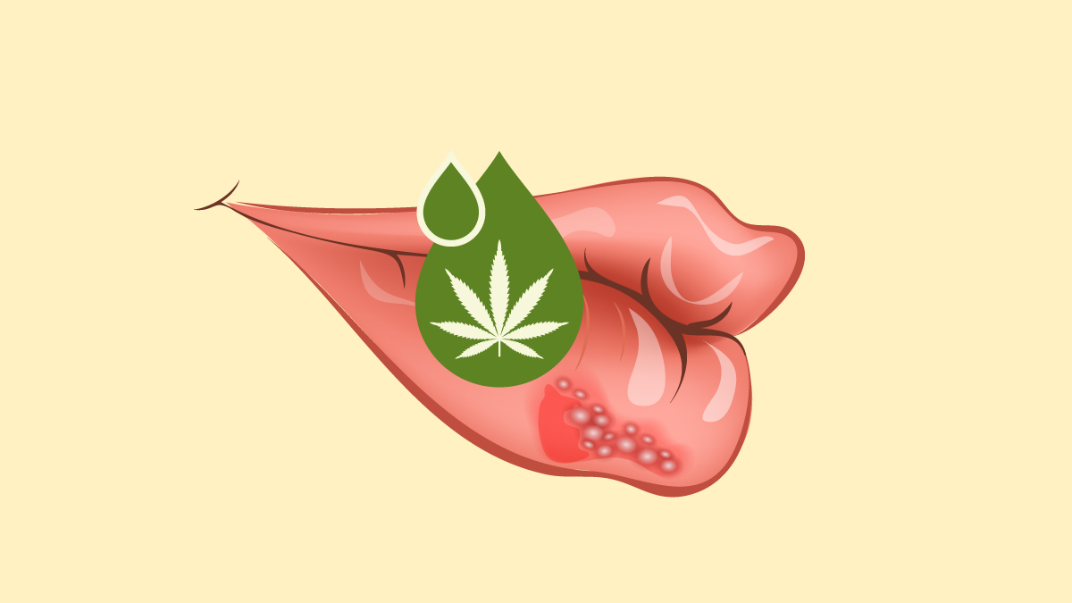 Illustration of cannabis treatment for a lip with herpes