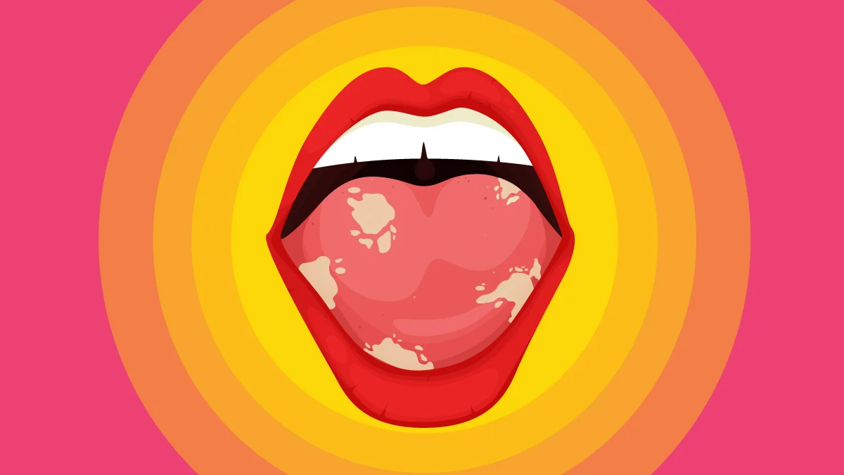 Illustration of Candida Existence on Mouth