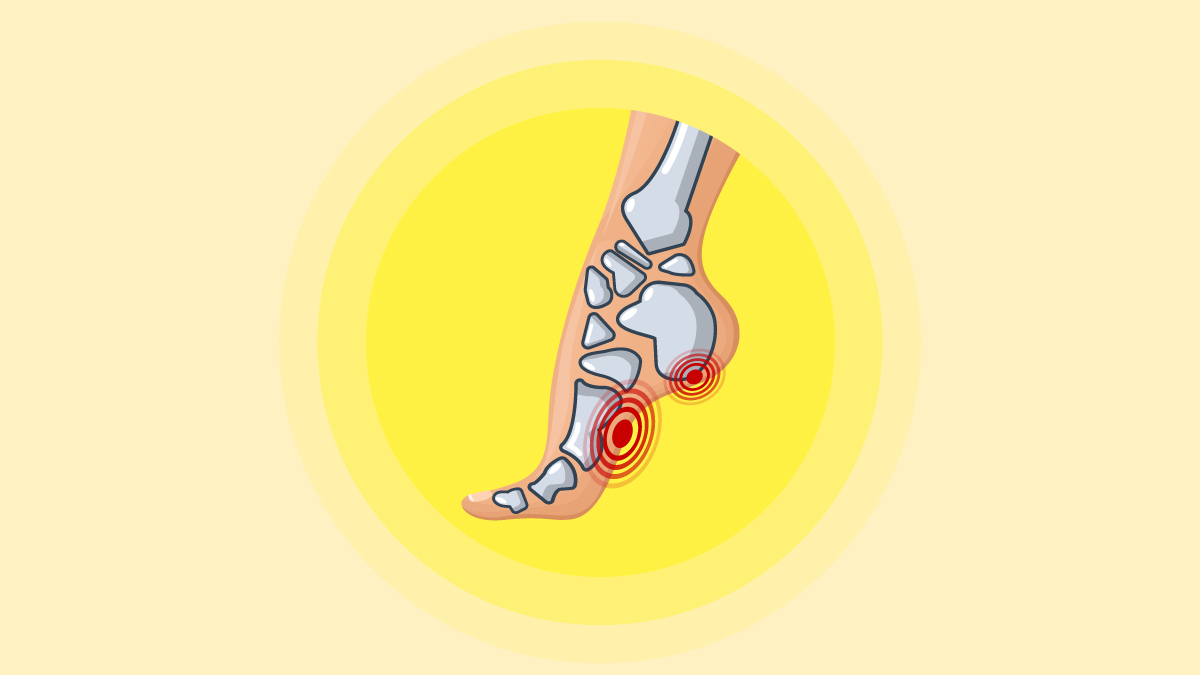 Illustration of Plantar Fascitis in a Yellow Background