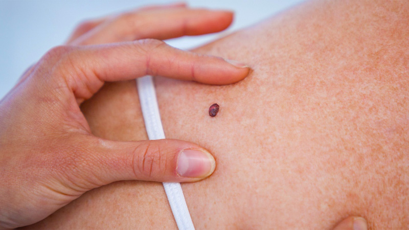 Image of skin cancer on a woman's shoulder