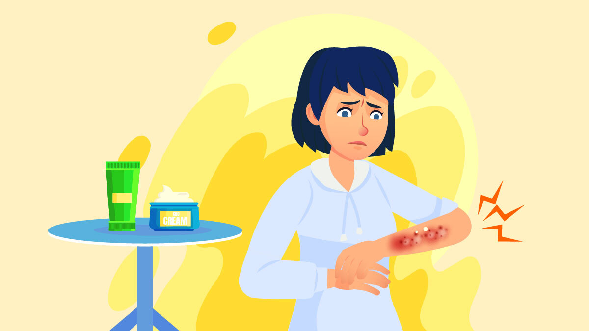 Illustration for best CBD cream for eczema and itching