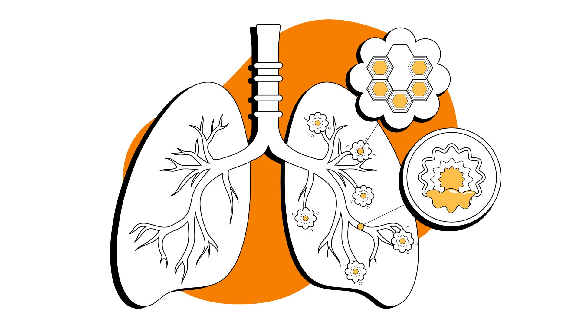 Illustration of lungs with COPD